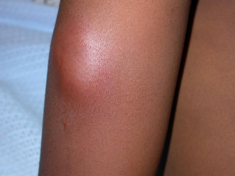 An abscess on the upper arm. There is almost no visible redness. What identifies it is the contour and the surface: a raised, rounded swelli