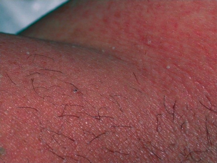 AGEP: dozens of tiny pinhead pustules sitting on a sheet of confluent redness, concentrated in a flexure. The individual pustules are small,