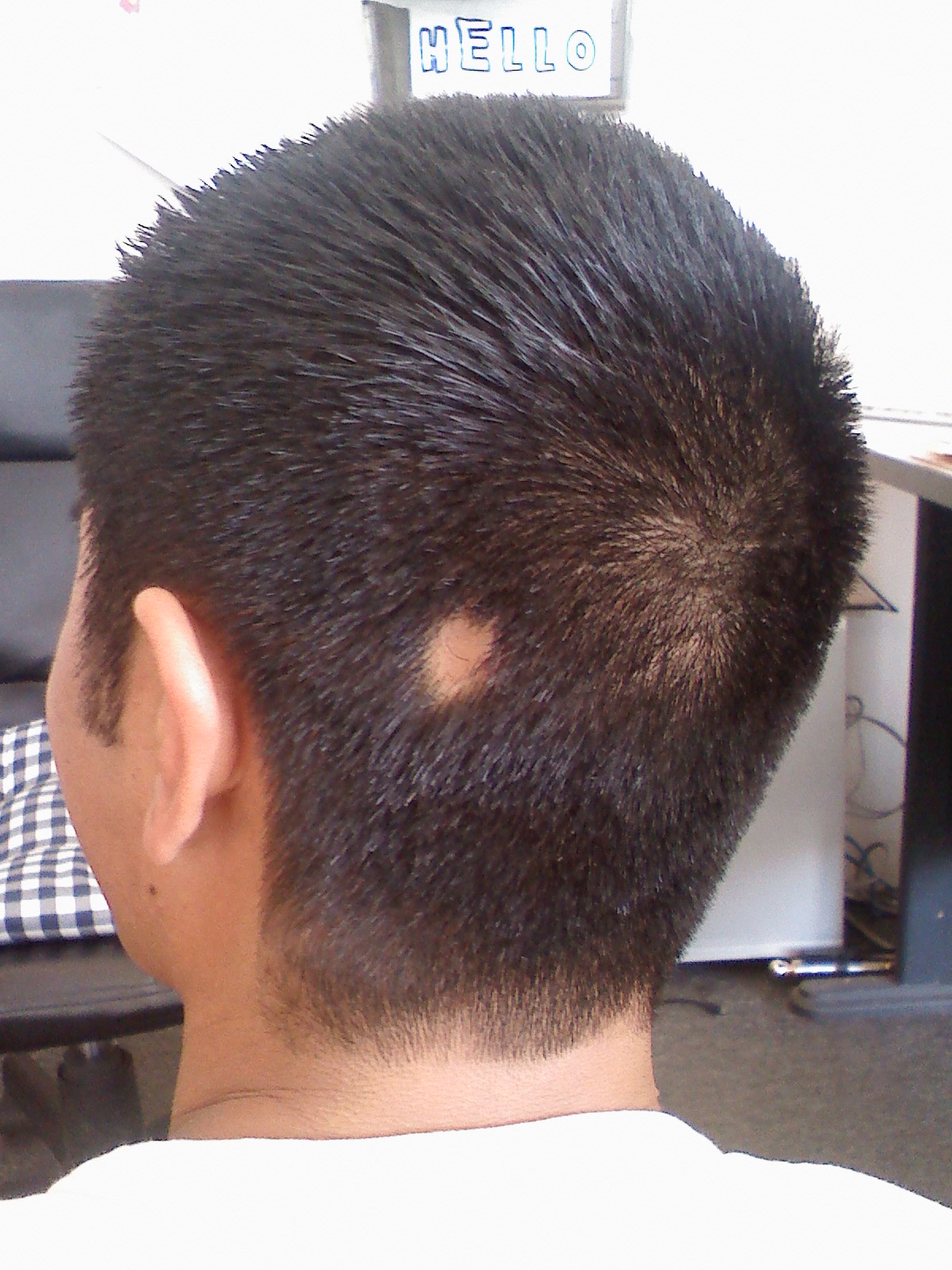 Alopecia areata on the occipital scalp. A single sharply circumscribed round patch of complete hair loss over entirely normal, smooth skin -