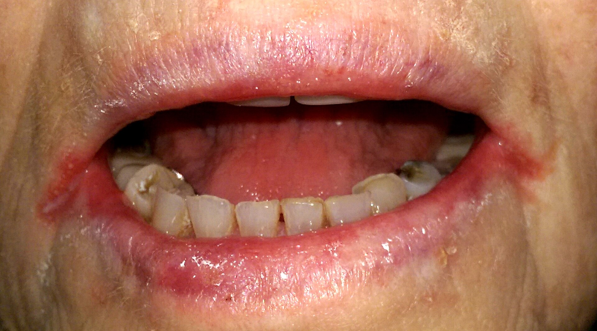 Bilateral angular cheilitis in an older person with dentures. Both corners of the mouth are red, macerated and fissured, with the inflammati