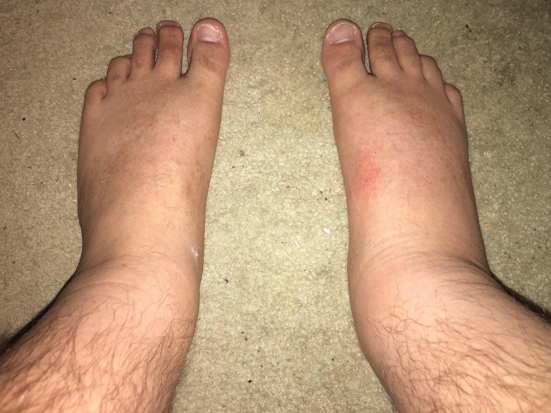 Early cellulitis of the right foot, photographed beside the unaffected left. The comparison is the examination. The right foot is swollen ac