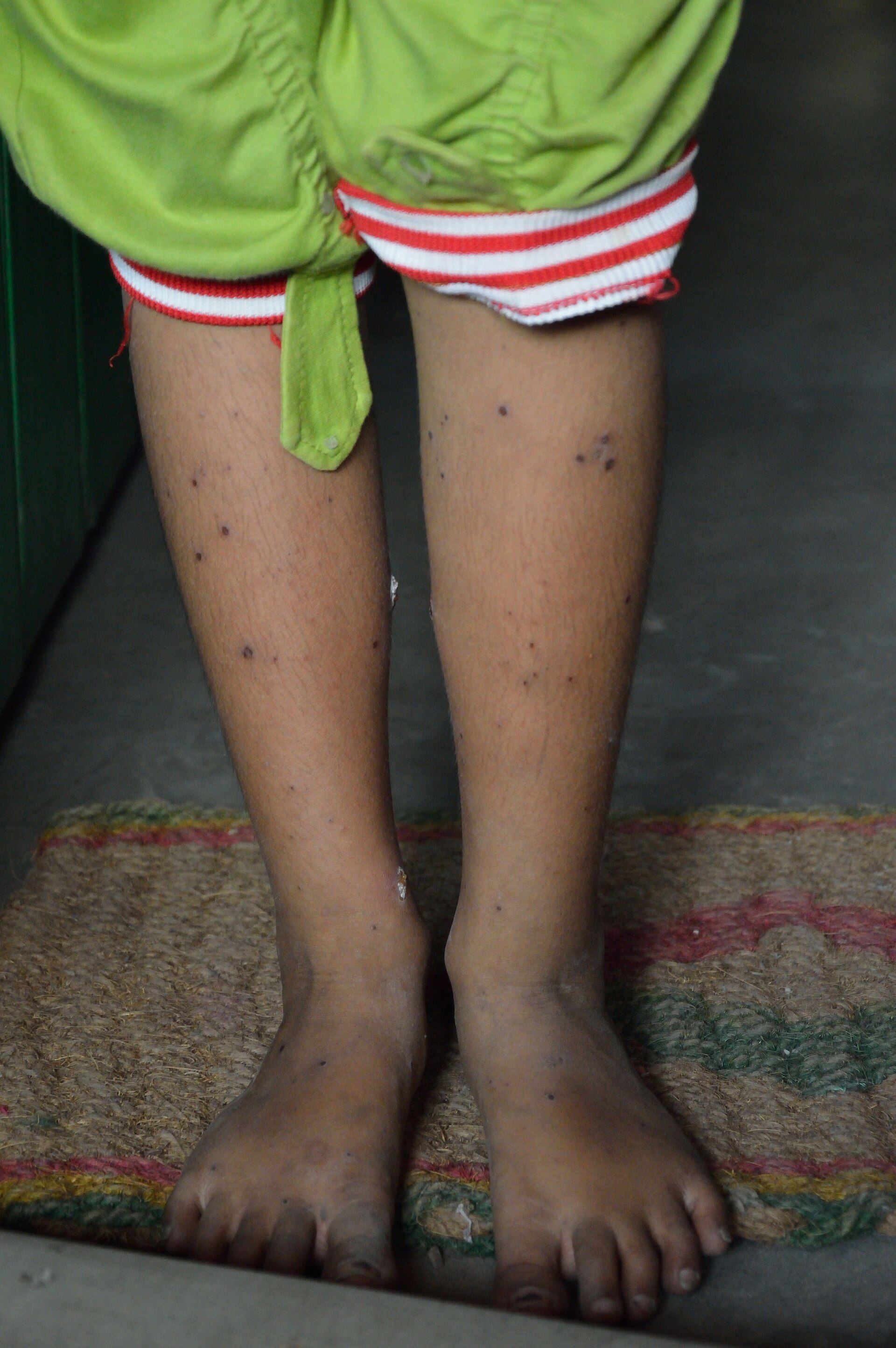 Chickenpox on brown skin, at the crusted stage. Almost nothing here looks like the textbook 'dewdrop on a rose petal'. There is no visible e