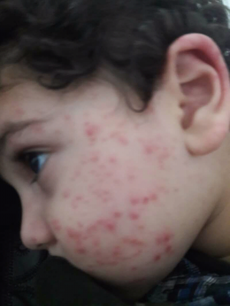 Gianotti-Crosti syndrome on a child's cheek. Monomorphous papules, all of one size and one age, scattered over the cheek - and the cheek is
