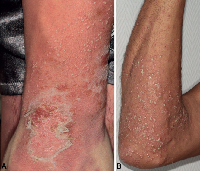 Generalised pustular psoriasis in two patients. (A) Sheets of confluent erythema studded with pustules that have run together into a 'pustul