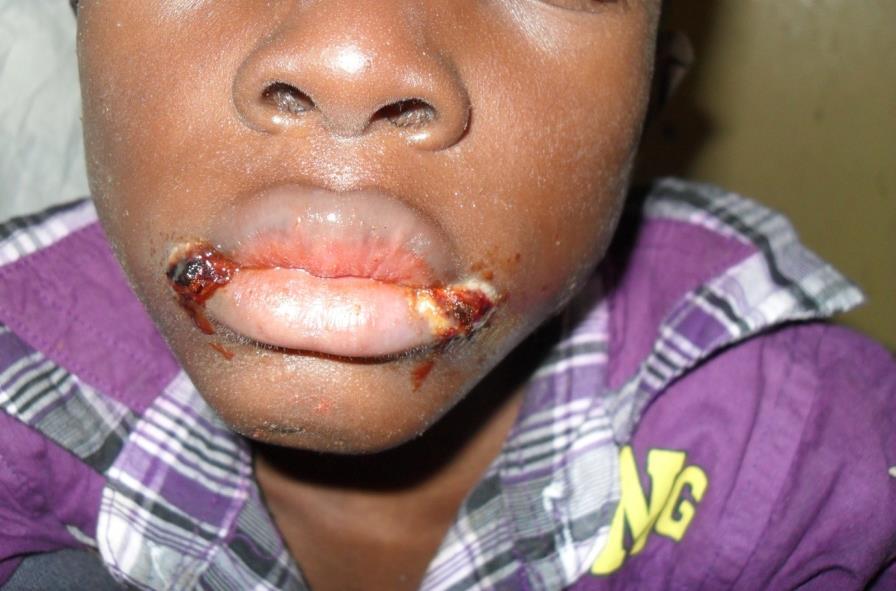 Herpes simplex with angular stomatitis - crusted, fissured, bleeding lesions at both corners of the mouth. Worth knowing because the reflex