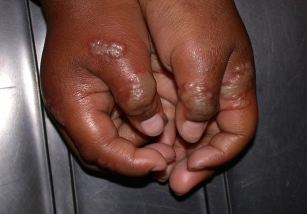 Herpetic whitlow. Grouped vesicles on the fingers - the grouping is the diagnostic feature, and it survives any skin tone, because it is abo