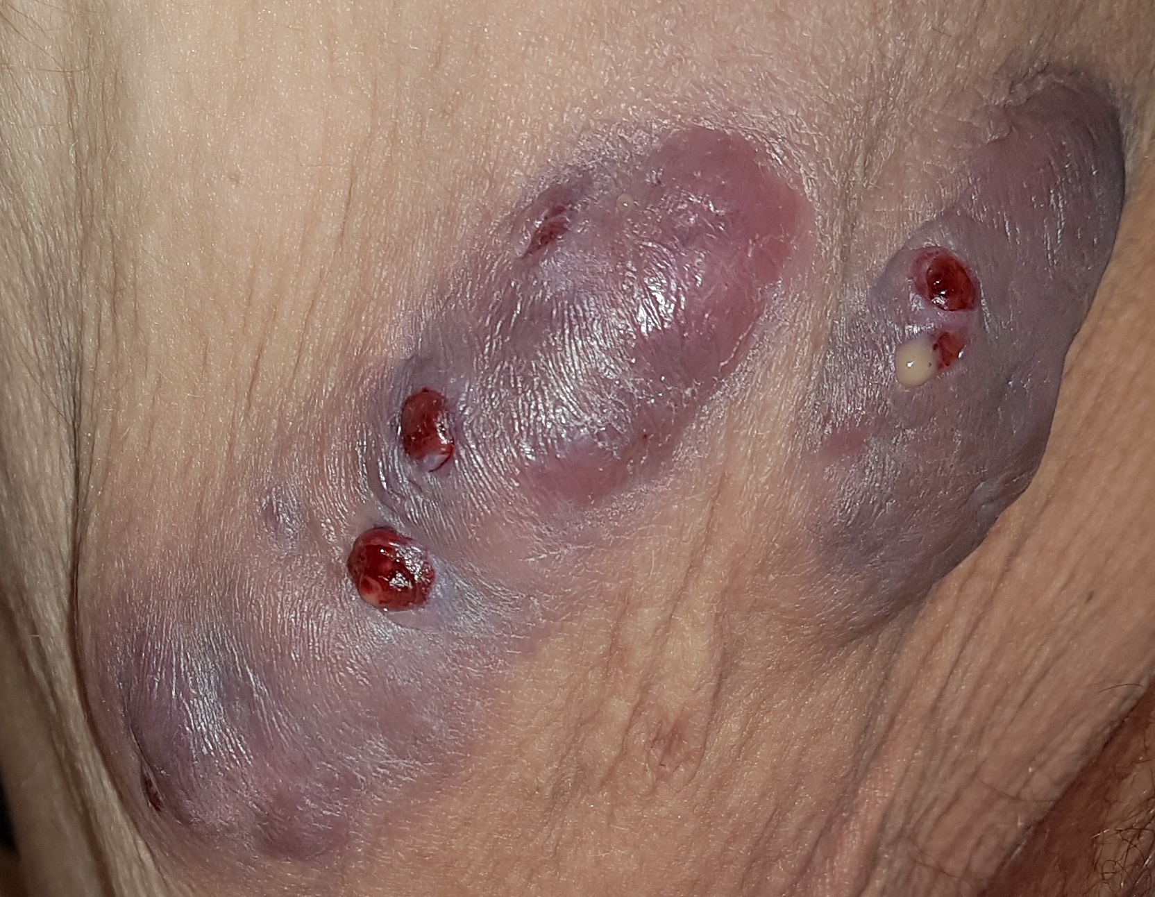 Hidradenitis suppurativa in a flexure. Several deep inflammatory nodules, two of them discharging - one bloody, one with a bead of pus - set