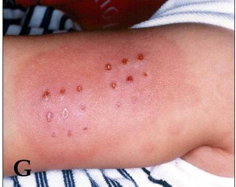 Redness and induration at the site of an earlier BCG vaccination - small crusted papules on an inflamed plaque over the deltoid. This is clo