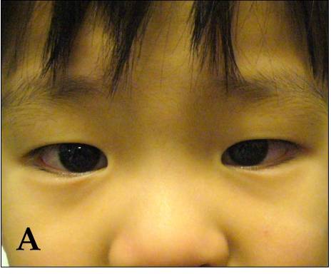 Bilateral conjunctival injection in Kawasaki disease. Both eyes are red, there is no pus and no stickiness - this is a non-exudative conjunc