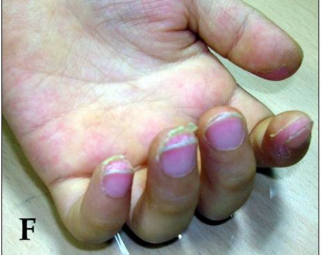 Peeling of the fingers in the subacute phase. Sheets of skin lift from the fingertips and the edges of the nails first and work backwards, t