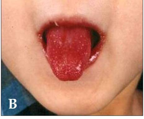Mouth signs in Kawasaki disease: a strawberry tongue with prominent papillae, and lips that are deep red, dry and vertically cracked. There