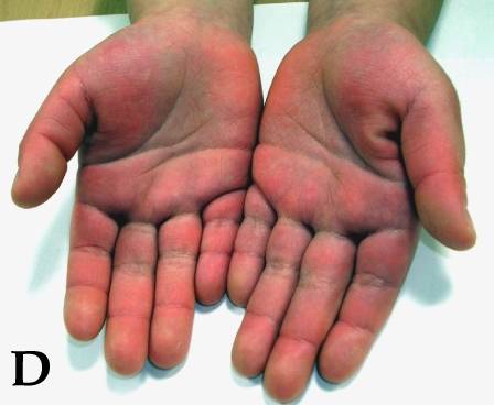 Erythema of both palms in the acute phase, usually with firm, painful swelling of the backs of the hands. Palms and soles are the one place