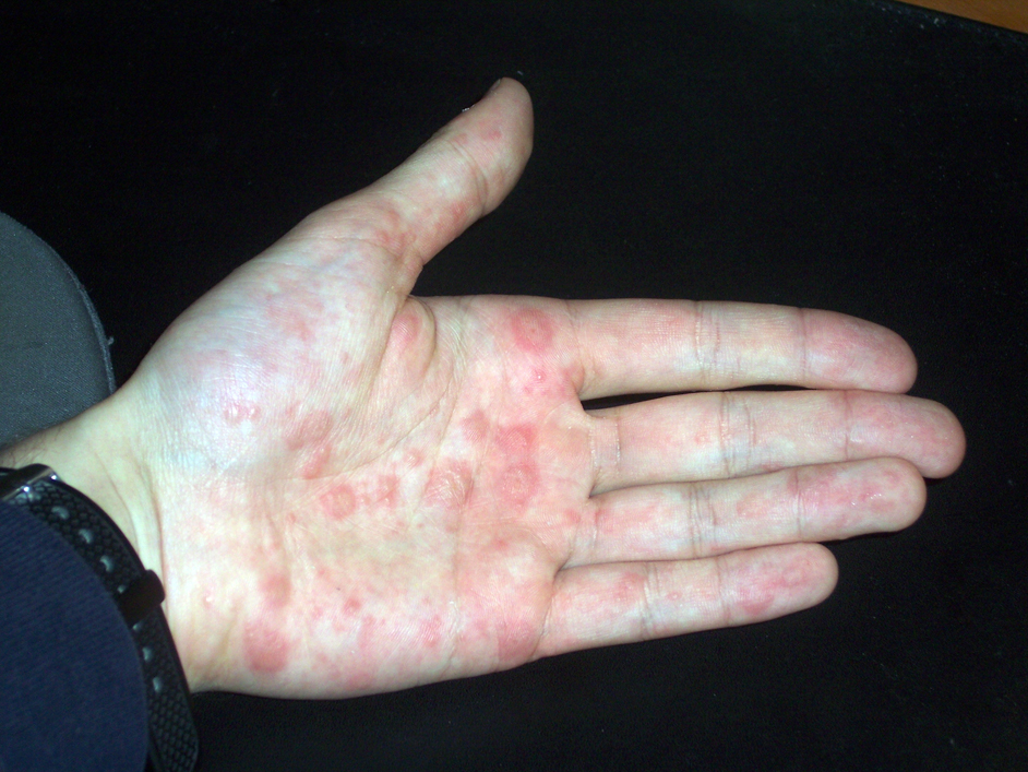Pompholyx affecting the palm and fingers. Crops of small deep-seated vesicles that sit within the skin rather than on top of it, classically
