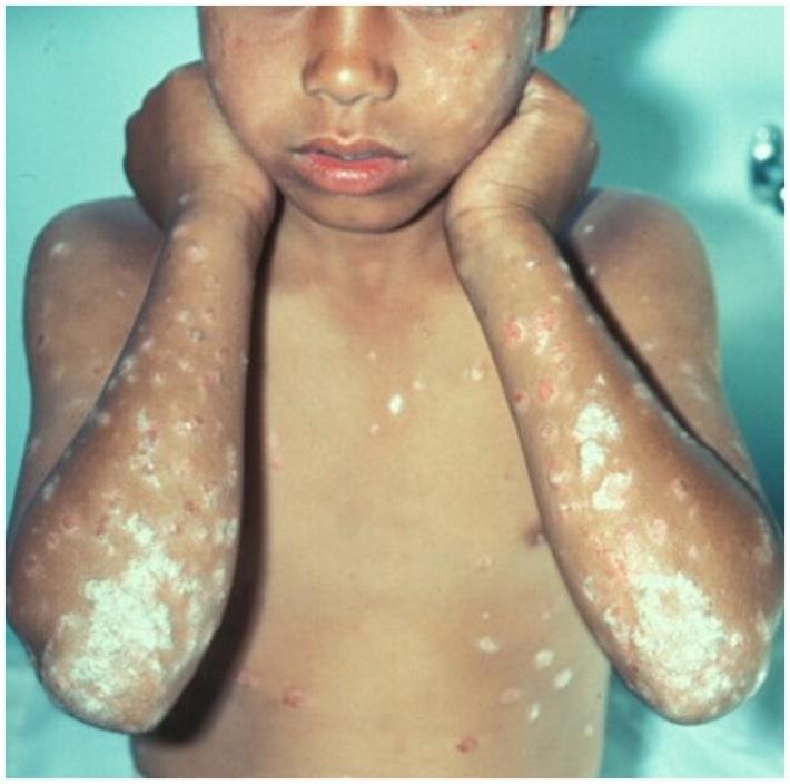 Psoriasis on the arms. The scale is thick and silvery-white and is the most visible feature; the plaque beneath it is violet-grey rather tha