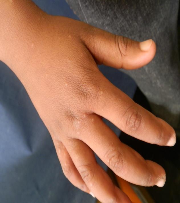 Scabies on the back of the hand and in the finger webs. The lesions are small pale or skin-coloured papules - against brown skin they read a