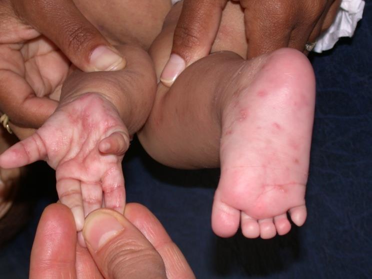 Infantile scabies on the palms and soles, which is a distribution seen in babies and not in older children or adults. On the pale palmoplant
