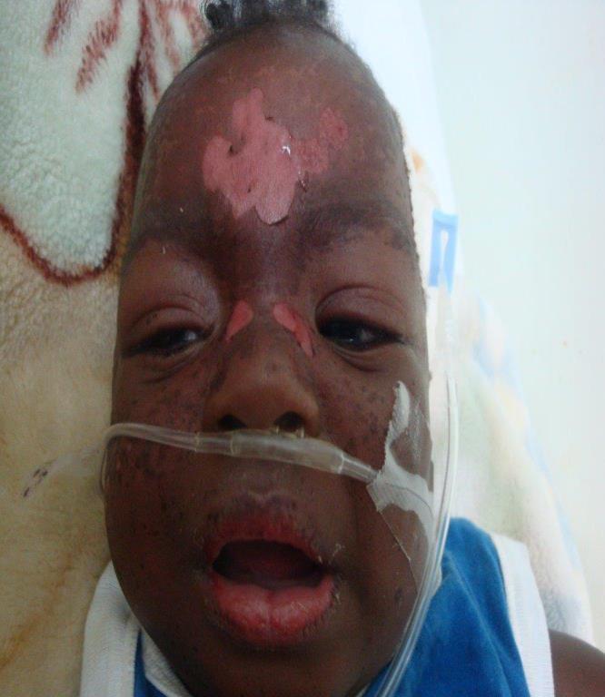 Stevens-Johnson syndrome in an infant. Two things to take from this: the focal areas of stripping on the forehead, where pink dermis is expo