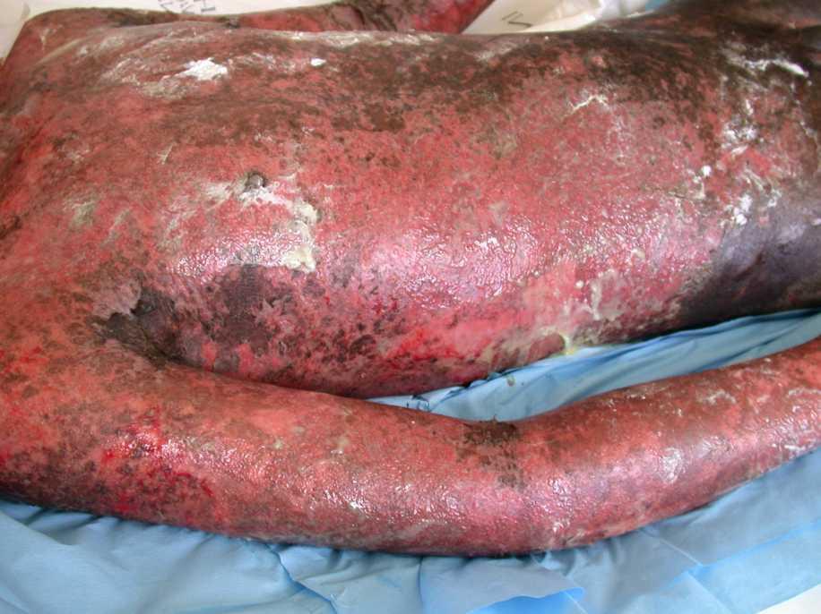 Toxic epidermal necrolysis on dark skin. Where the epidermis has sheared away the exposed dermis is raw and red; where it is still attached